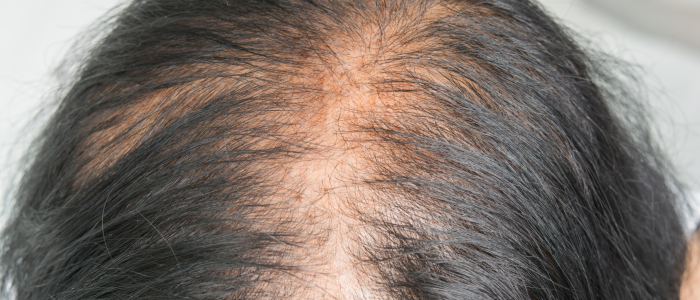Female Baldness The Treatments Available For This Problem