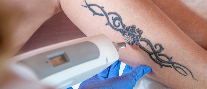 Is Laser Tattoo Removal Better Over The Creams?