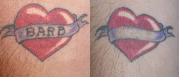 A few best tattoo numbing creams which have been considered as the best by the public